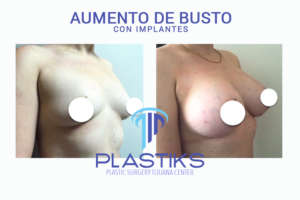 En Cirugía Plástica Tijuana el cirujano plástico Dr. Rafael Camberos Solís ofrece servicios de aumento de busto en Tijuana, México.