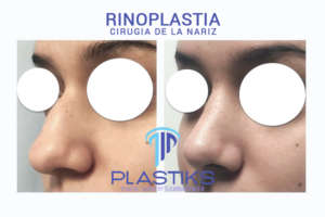 En Cirugía Plástica Tijuana el cirujano plástico Dr. Rafael Camberos Solís ofrece servicios de rinoplastia en Tijuana, México.